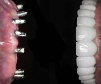 زراعة الأسنان الفورية في تبريز