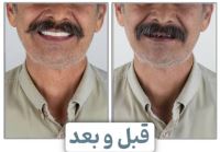 زراعة الأسنان الفورية في تبريز