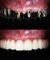 زراعة الأسنان الفورية في تبريز