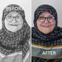 زراعة الأسنان الفورية في تبريز