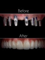 زراعة الأسنان الفورية في تبريز