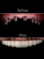 زراعة الأسنان الفورية في تبريز