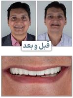 زراعة الأسنان الفورية في تبريز