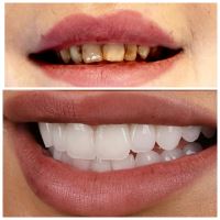 ایمپلنت دندان در صادقیه