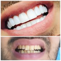 ایمپلنت دندان در صادقیه