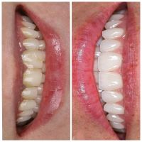 ایمپلنت دندان در صادقیه