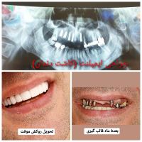 ایمپلنت دندان در صادقیه