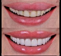 ایمپلنت دندان در صادقیه