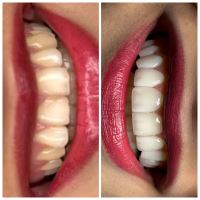 ایمپلنت دندان در صادقیه