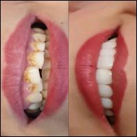 ایمپلنت دندان در صادقیه