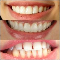 ایمپلنت دندان در صادقیه