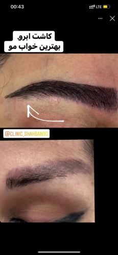 کاشت مو و ابرو در ساری