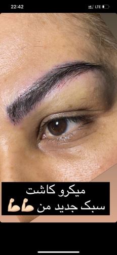 کاشت مو و ابرو در ساری