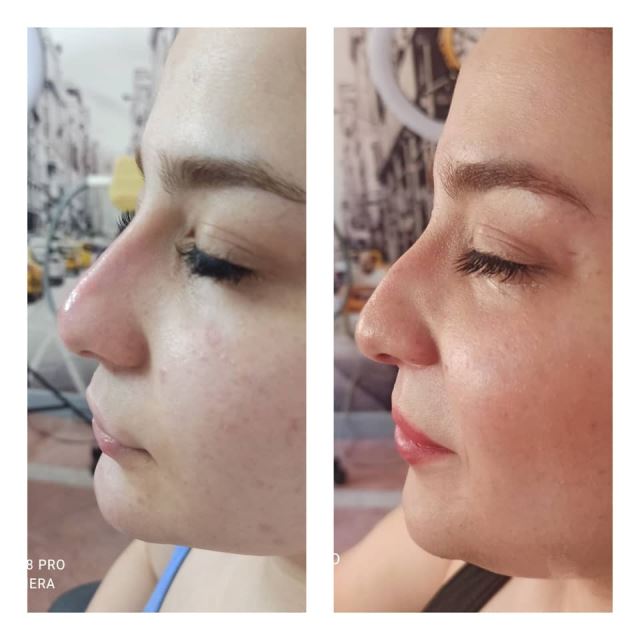 فیشیال صورت در سعادت آباد 