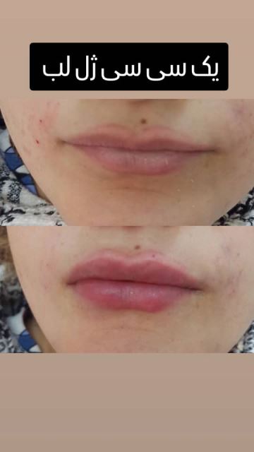 فیشیال صورت در سعادت آباد 