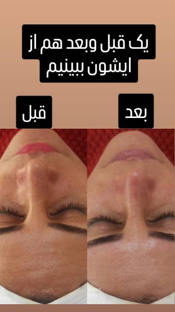 فیشیال صورت در سعادت آباد 