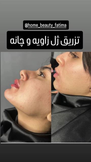 فیشیال صورت در سعادت آباد 