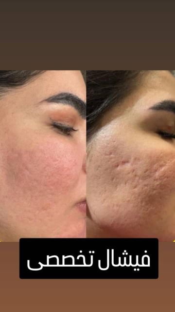 فیشیال صورت در سعادت آباد 