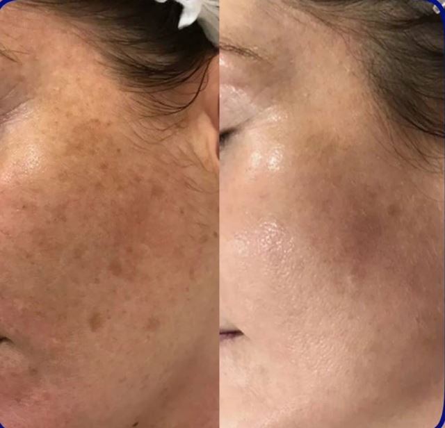 فیشیال صورت در سعادت آباد 