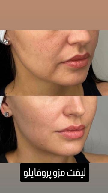 فیشیال صورت در سعادت آباد 