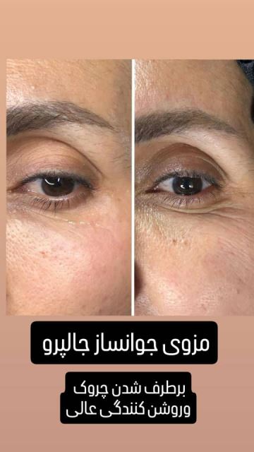فیشیال صورت در سعادت آباد 