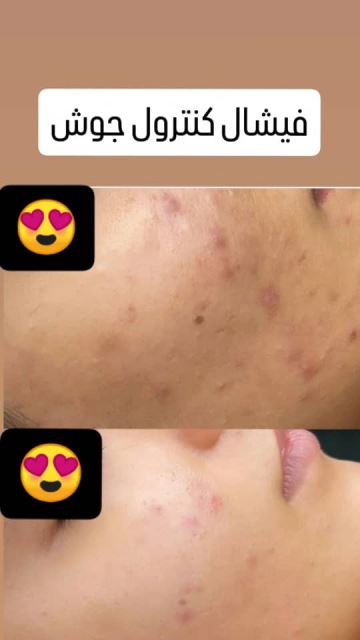 فیشیال صورت در سعادت آباد 