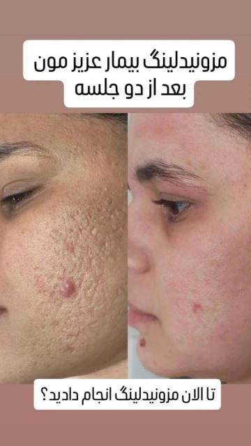 فیشیال صورت در سعادت آباد 