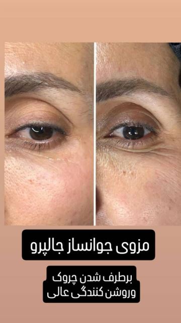 فیشیال صورت در سعادت آباد 