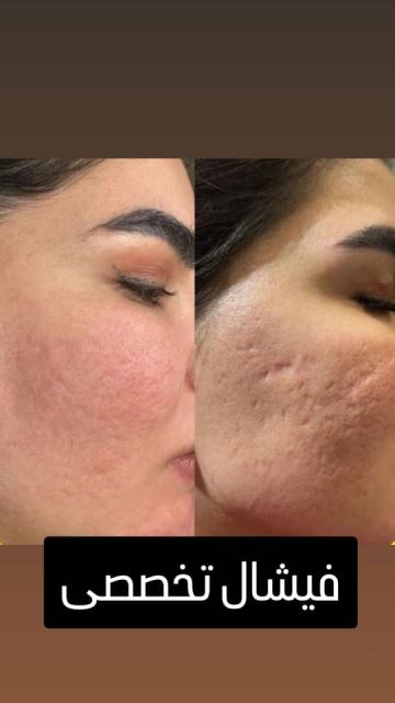 فیشیال صورت در سعادت آباد 