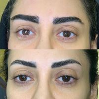 کلینیک کاشت ابرو در شیراز