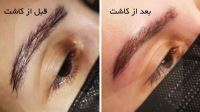 کلینیک کاشت ابرو در شیراز