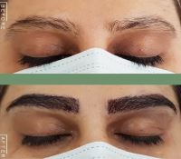 کلینیک کاشت ابرو در شیراز