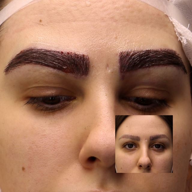 کاشت ابرو تضمینی در شیراز 