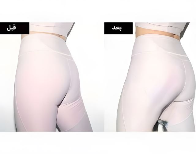 تزریق ژل باسن در اصفهان توسط پزشک متخصص | خدمات زیبایی با مشاوره تخصصی