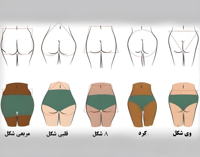 تزریق ژل باسن در اصفهان توسط پزشک متخصص | خدمات زیبایی با مشاوره تخصصی