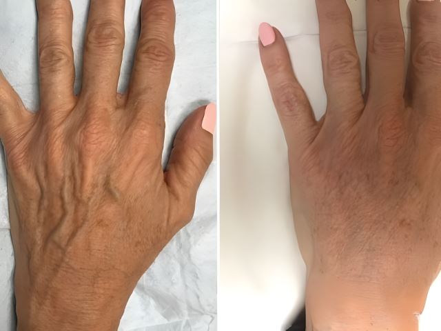 تزریق ژل دست در اصفهان