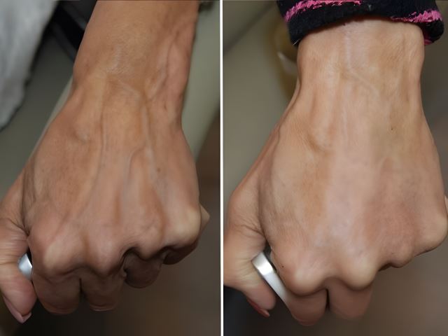 تزریق ژل دست در اصفهان