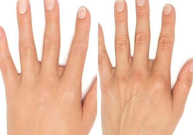 تزریق ژل دست در اصفهان