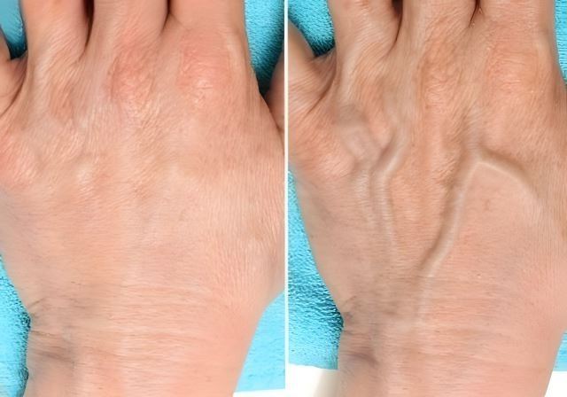 تزریق ژل دست در اصفهان