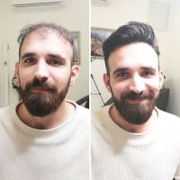 کاشت موی تخصصی در شیراز