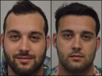 کاشت موی تخصصی در شیراز