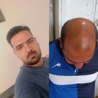 کاشت موی تخصصی در شیراز