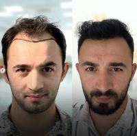 کاشت موی تخصصی در شیراز