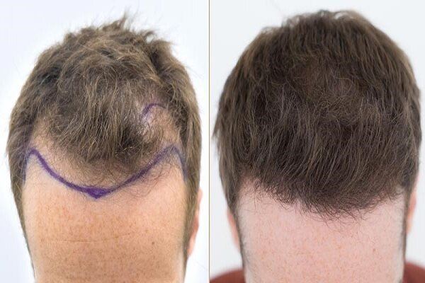 کاشت موی تخصصی در شیراز