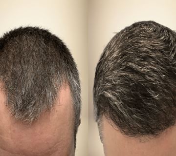 کاشت موی تخصصی در شیراز