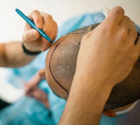 کاشت موی تخصصی در شیراز