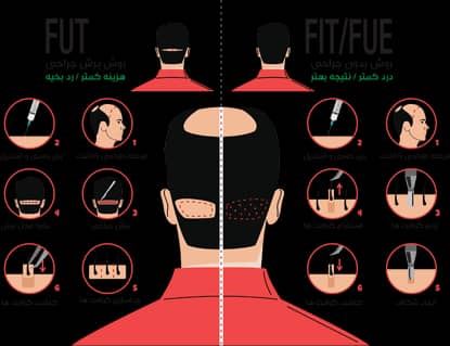 کاشت مو و ابرو تضمینی در غرب تهران 