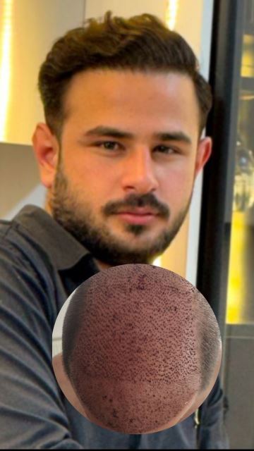 بهترین کلینیک کاشت مو در پارس آباد 