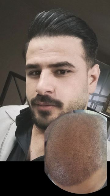 بهترین کلینیک کاشت مو در پارس آباد 