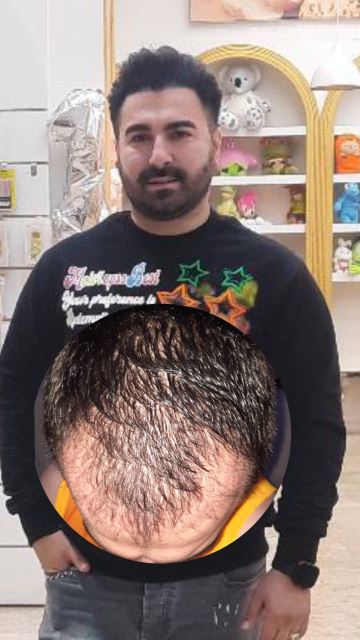 بهترین کلینیک کاشت مو در پارس آباد 